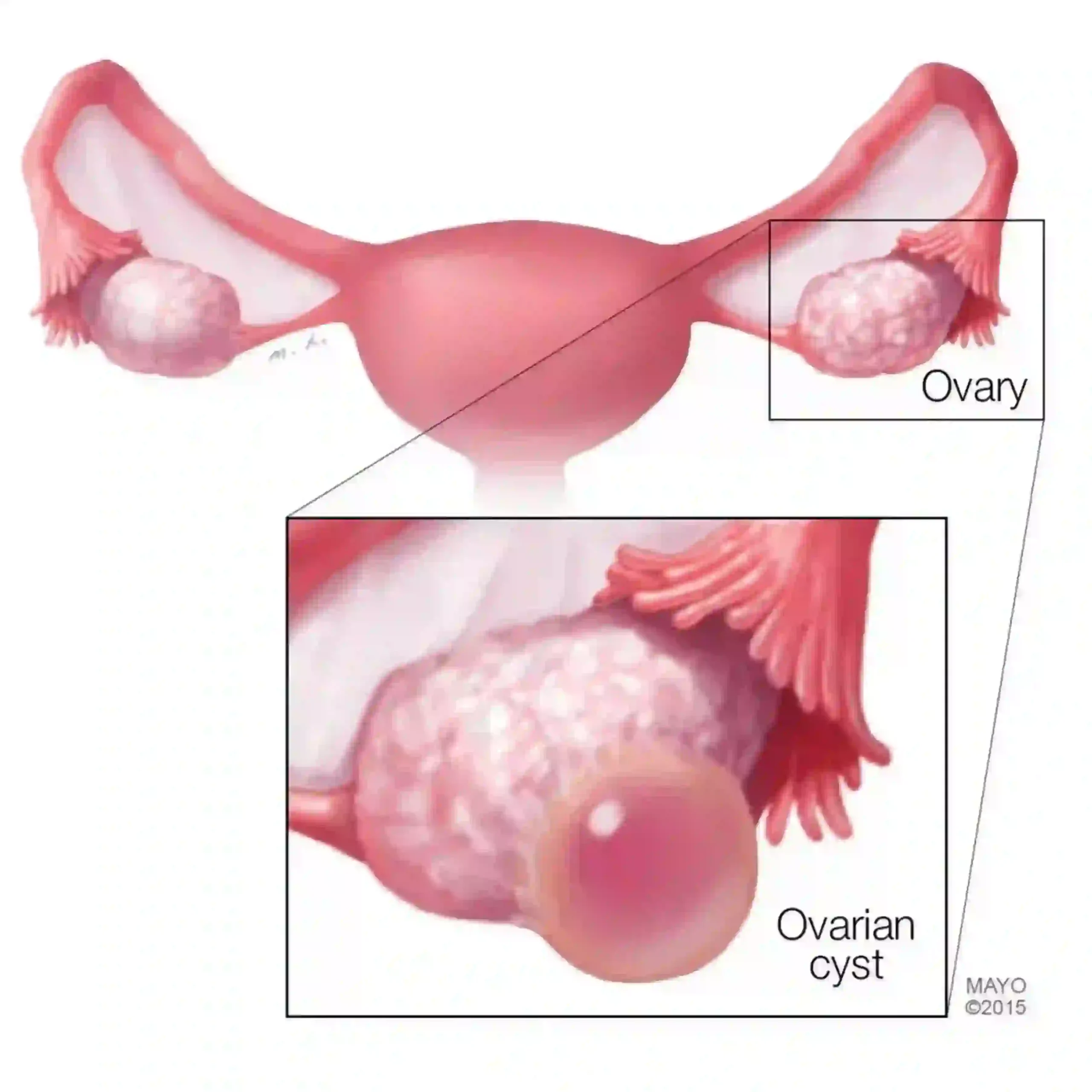 Ovarian cyst