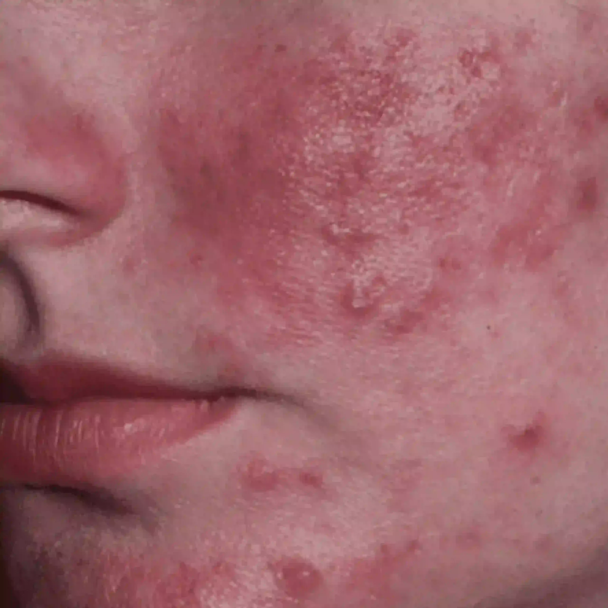 Acne Rosacea