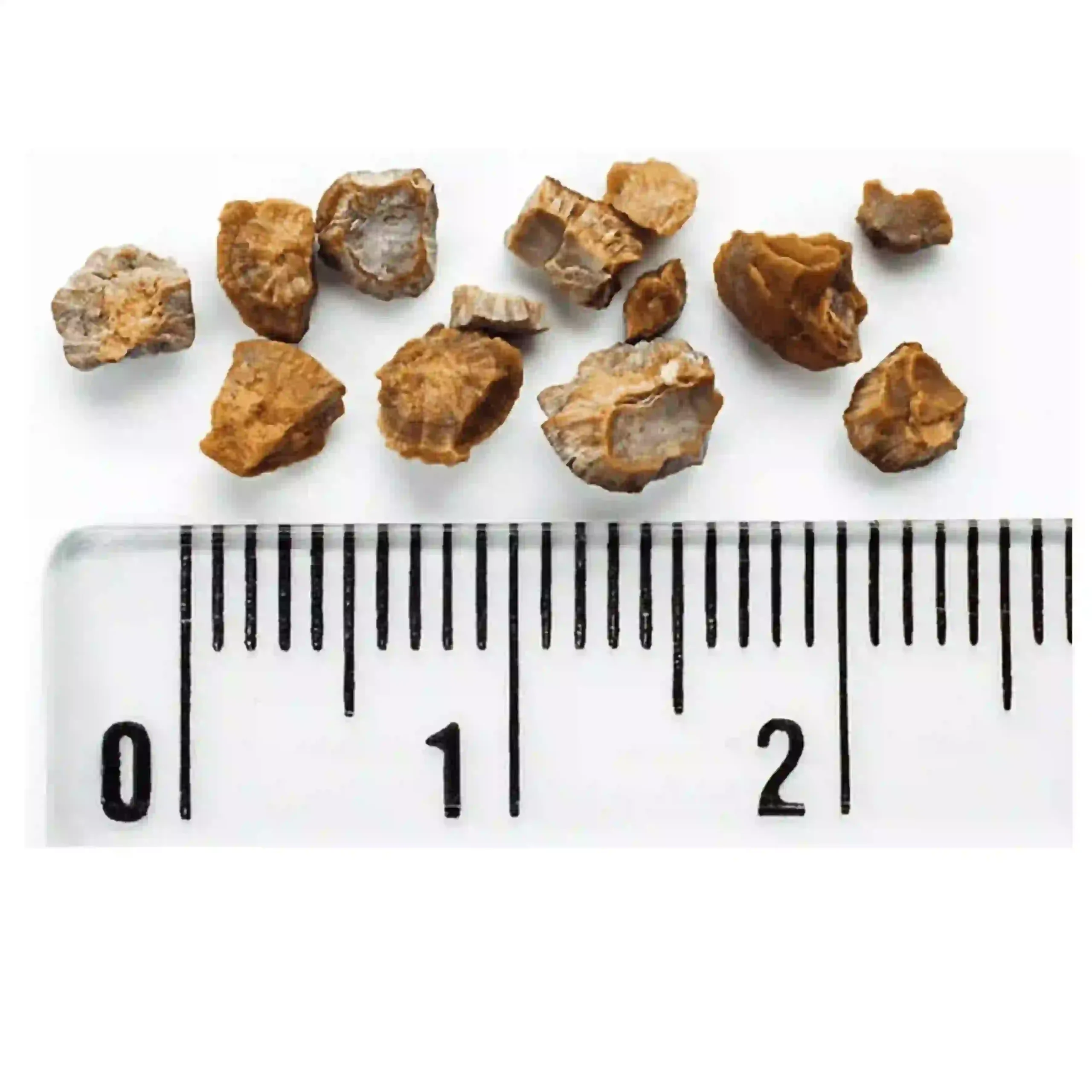 Kidney stones