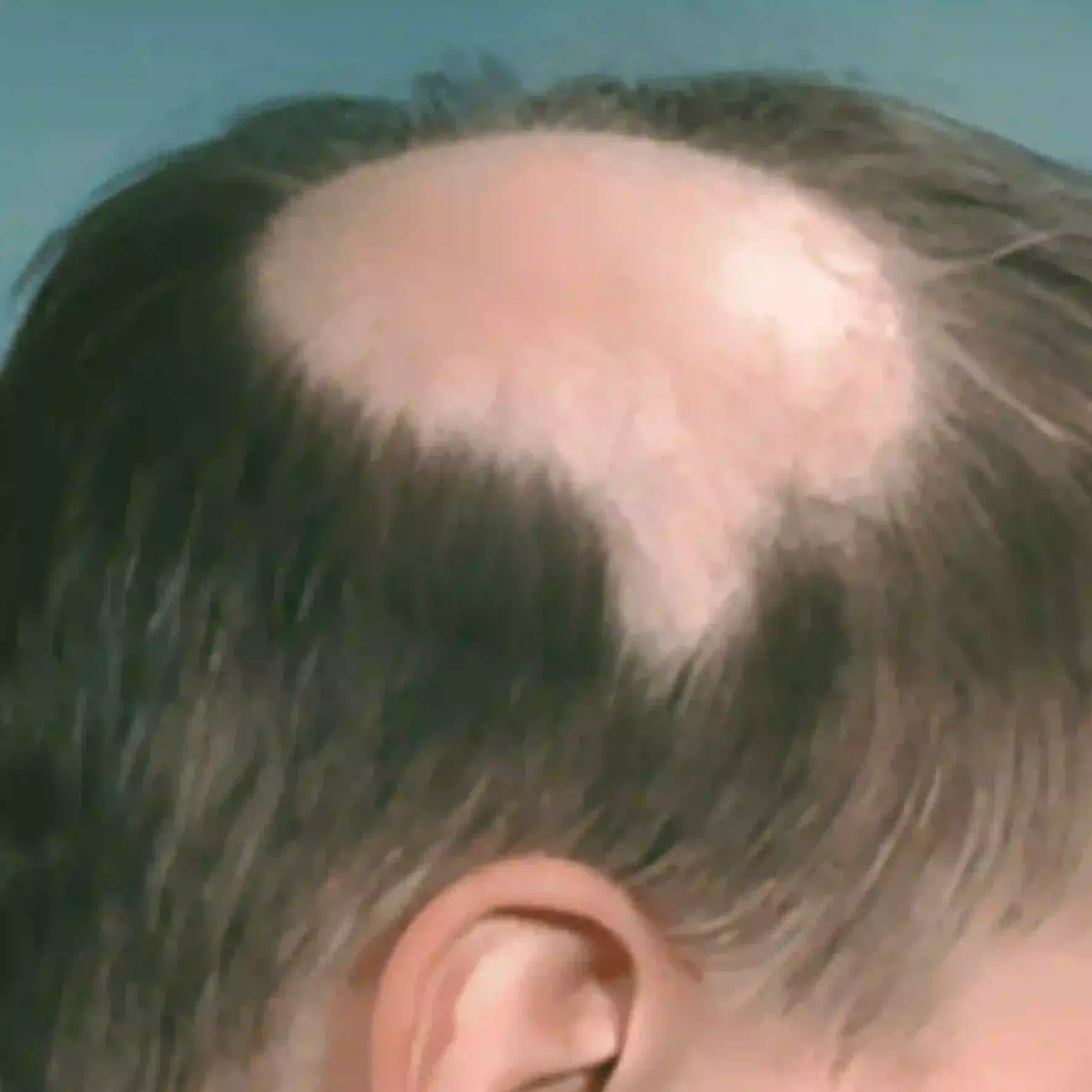 Alopecia Areata